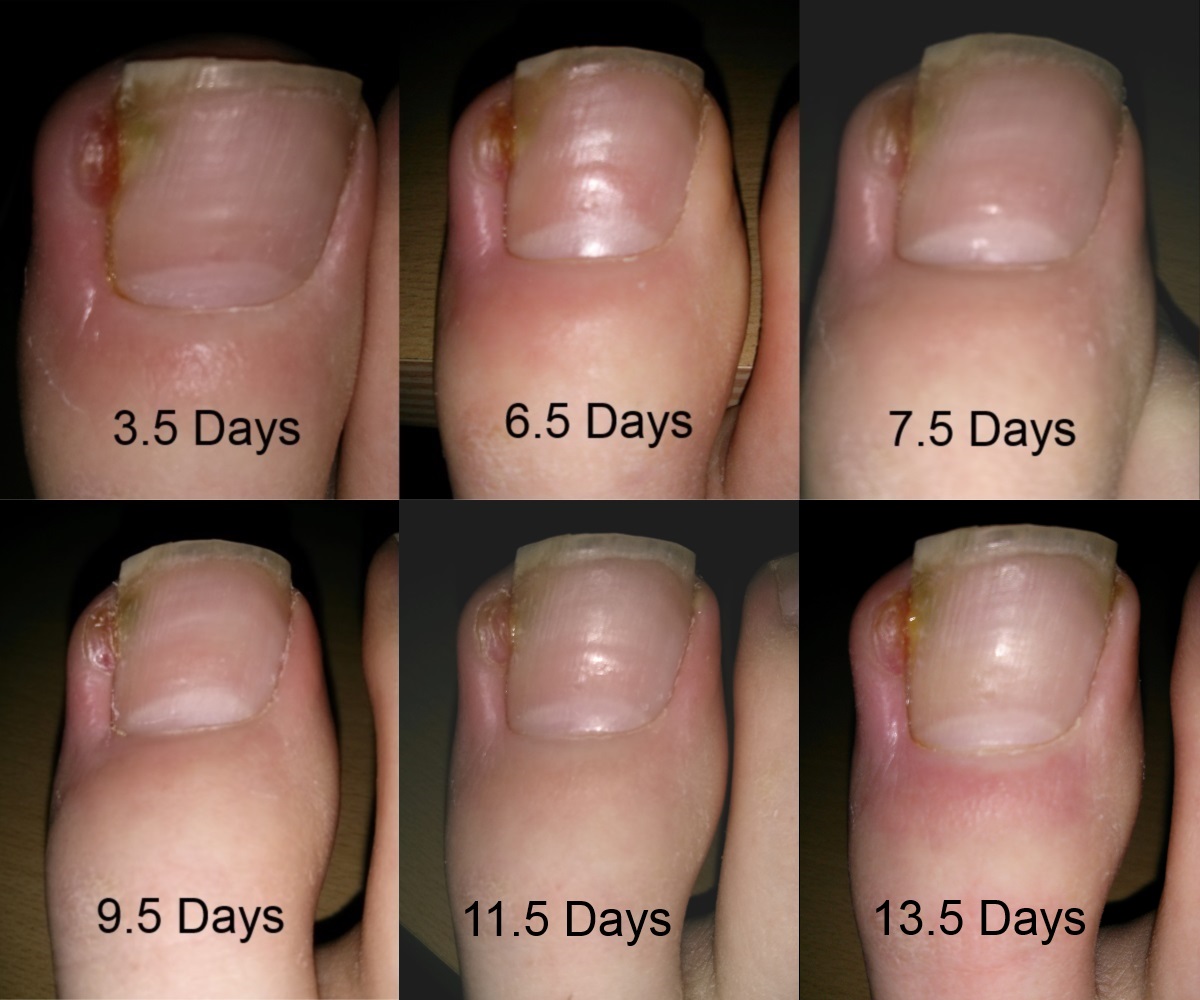 The Inside Ysis Great Ingrowing Toenails Saga Infected Ingrowing Toenail Right Toe Treating Pseudomonas Aeruginosa With Flucloxacillin
