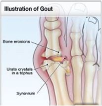 Natural home remedy for gout