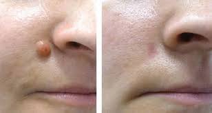 Removing Warts Effectively