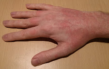 Skin GVHD - Right Hand