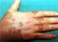 Health Tips: Vitiligo or Leucoderma or WHITE SKIN