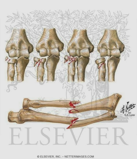 橈骨頭骨折 Radial Head Fracture 小小整理網站smallcollation