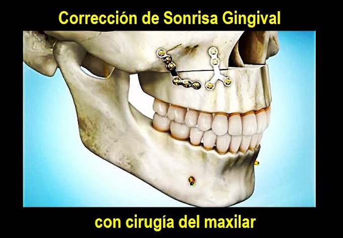 SONRISA GINGIVAL: Corrección con cirugía del maxilar