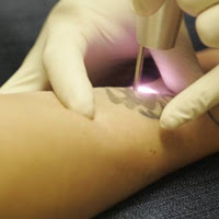 Post image for Are You Thinking of Removing that Tattoo?