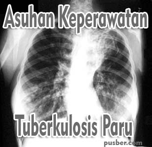 Asuhan Keperawatan (ASKEP) Pasien Tuberkulosis Paru