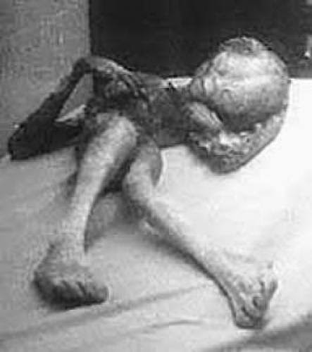 Uk During An Abduction Alien Killed With A Coal Shovel