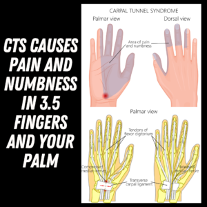 Carpal tunnel syndrome explained