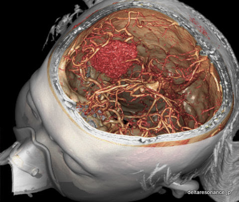 写真：脳内出血