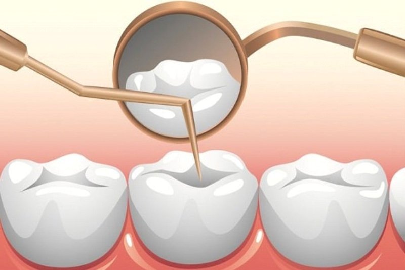 Trám răng là phương pháp nhanh chóng và có chi phí hợp lý