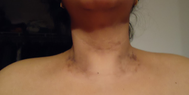 Dark spots on my neck - What is this?": Skin &amp; Beauty Community 