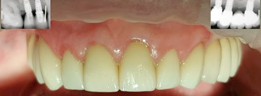 Dr Escaut André - Parodontiste - parodontologie, implants dentaires, couronnes dentaires