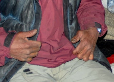 Missing fingers, typical collateral damage for high-altitude expedition workers 