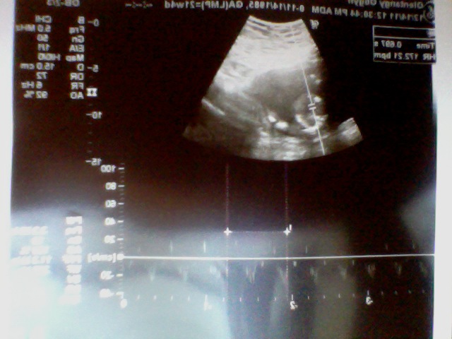 Baby's Heart