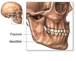 Artrita - Afecțiuni ale articulației temporo-mandibulare - dr. aristide - dentist bun in Bucuresti