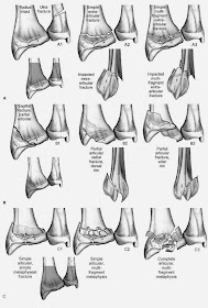 What Is A Nondisplaced Fracture 踝關節骨折(Ankle fracture)-lh6.googleusercontent.com