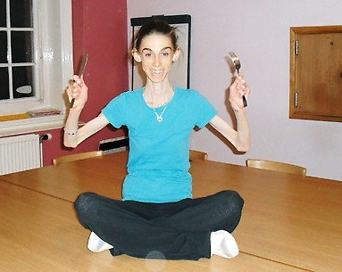 A triste e falsa beleza da anorexia - Parte 3