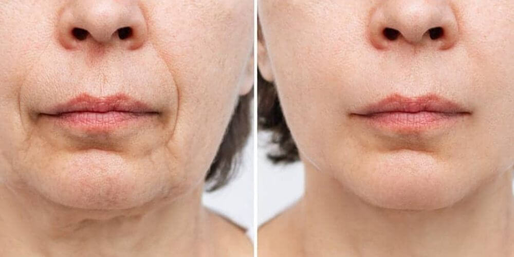 Avant et après une chirurgie esthétique bas du visage et cou