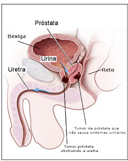 Localização do câncer de próstata
