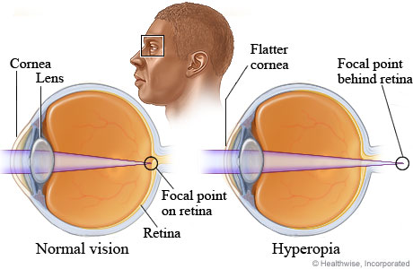 hipermetropia apare ca urmare manga despre vedere