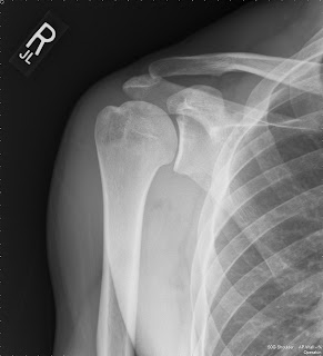 Shoulder Arthritis / Rotator Cuff Tears: causes of shoulder pain: X-rays for shoulder arthritis