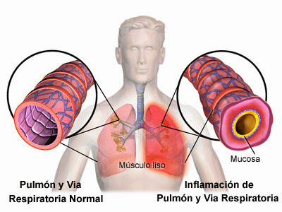 Resultado de imagen para bronquitis