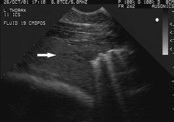 Sonogram of the left side of the thorax in the 11th intercostal space obtained from a horse with hemothorax.