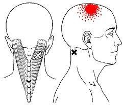 [最も共有された！ √] top back head headache 345444-Headache top back of head left side