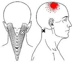 いろいろ back headache 701502-Back headache pain