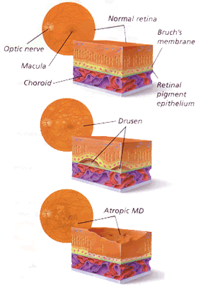 Obat Mata AMD
