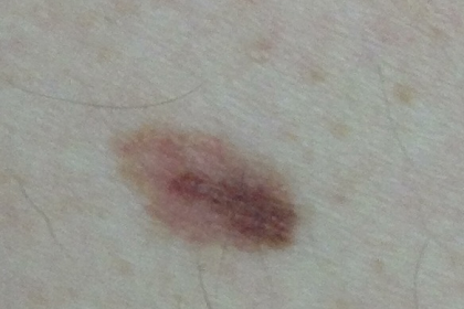 Melanoma Symptoms Stage 2