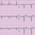 Errato posizionamento degli elettrodi ECG: quando sospettarlo?