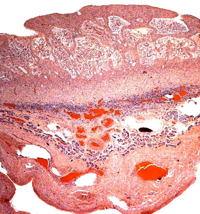 Full thickness of uterus with autolyzed caruncle at top, endometrial glands in the center and myometrium below