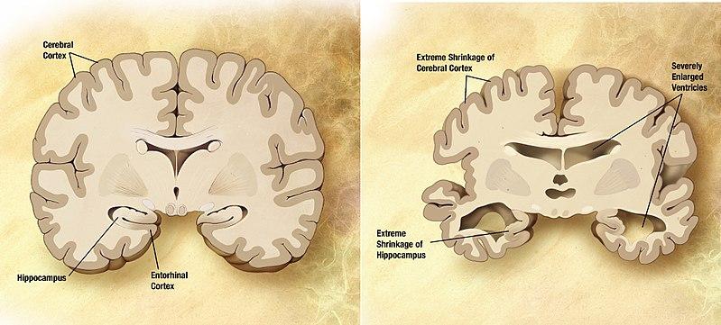 Fichier: Comparaison cérébrale de la maladie d'Alzheimer.jpg