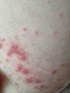 HFMD hand, Foot and mouth disease rash on leg