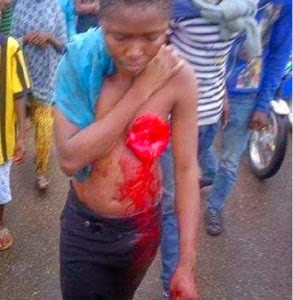 Photo Of A Girl Who's Breast Was Sliced Off By Suspected Ritualists In Ado Ekiti 3