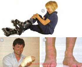 21. She fell down 22. he hurt his hand 23. He sprained his ankle Minor ailments, remedies at the pharmacy - Health - Photo Dictionary Online