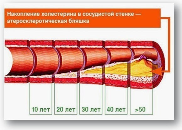Лечиться от холестерина народными средствами