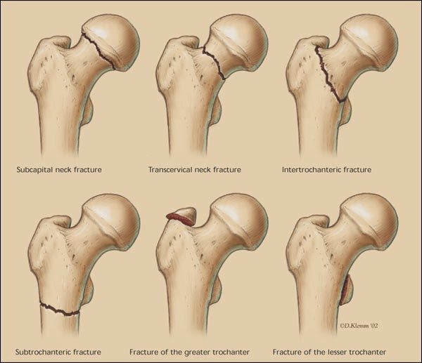 Deforma artroza articulațiilor cotului 3 grade - Artroza stadiului 1 al articulației umărului