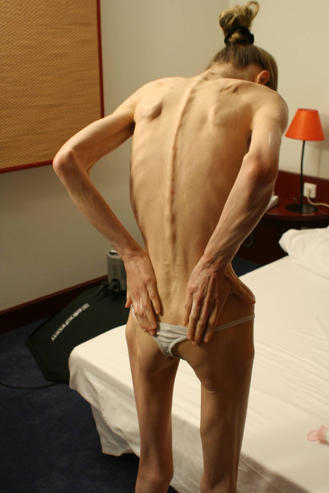 Fotos de jovens sob os efeitos da Anorexia Nervosa Fotos de jovens sob os efeitos da Anorexia Nervosa