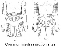 Insulin Injection Sites Diagram Insulin Injection Sites Diagram