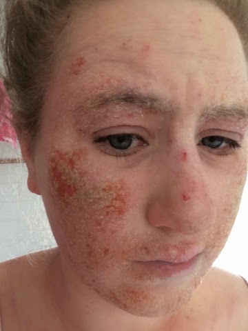 Topical steroid withdrawal shedding skin