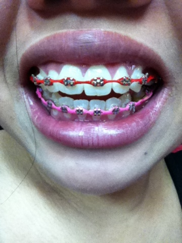 hot pink braces