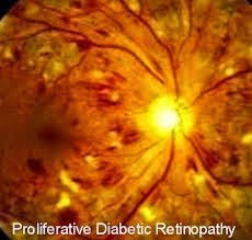Cara Mencegah Penyakit Retinopati Diabetes