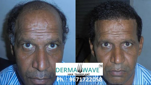 Dermawave Hair Transplant & Ashi Skin and Laser Clinic, II b3,, Nehru Nagar, Near Tata Motors, Old Basant Cinema, Ghaziabaad, Uttar Pradesh 201002, India, Hair_Transplantation_Clinic, state UP