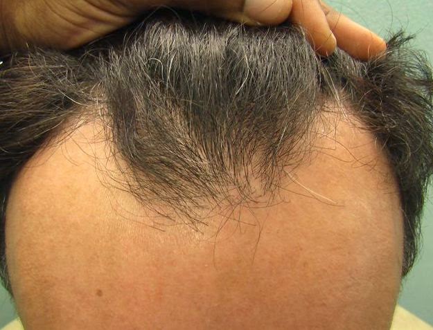 hair loss types