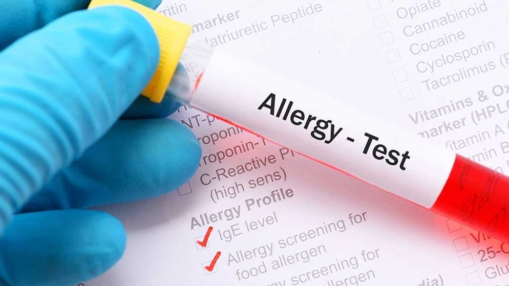 Элиминационная проба. Методы диагностики аллергии. Диагностика аллергии методом IMMUNOCAP. Маркеры аллергии