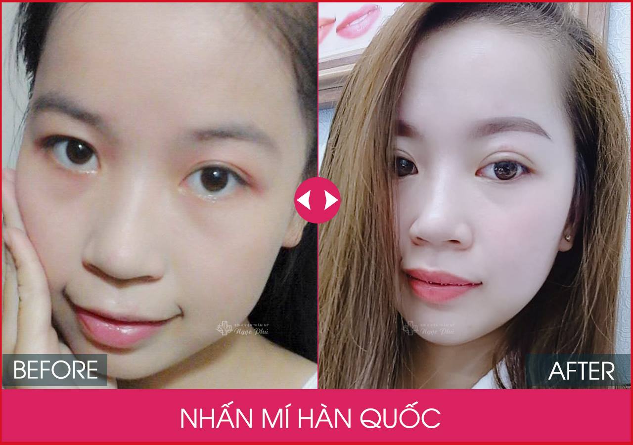 Khách hàng nhấn mí tại Bệnh viện Thẩm mỹ Ngọc Phú