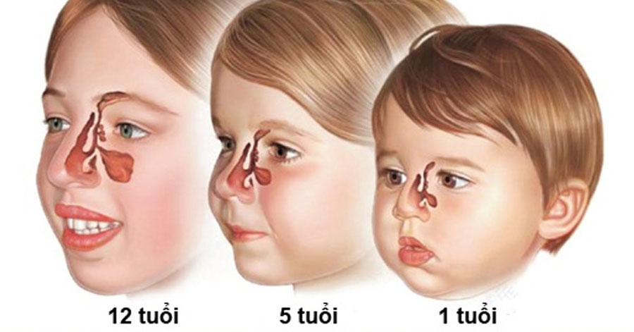 Chảy nước mũi kéo dài ở trẻ nhỏ và những bệnh lý liên quan