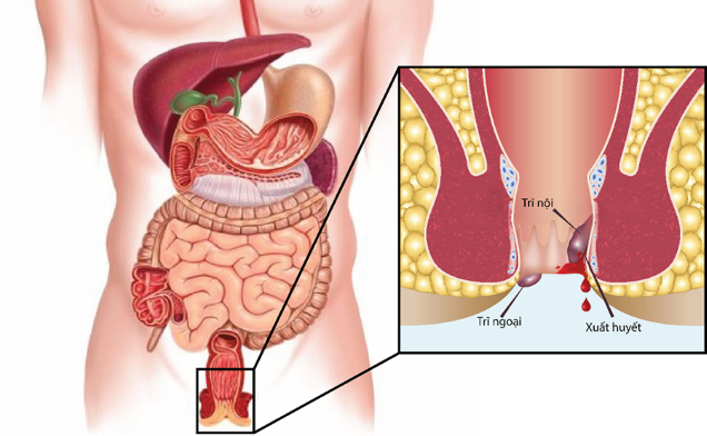 dược phẩm trị trĩ ngoại