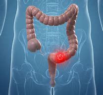 Understanding colon cancer